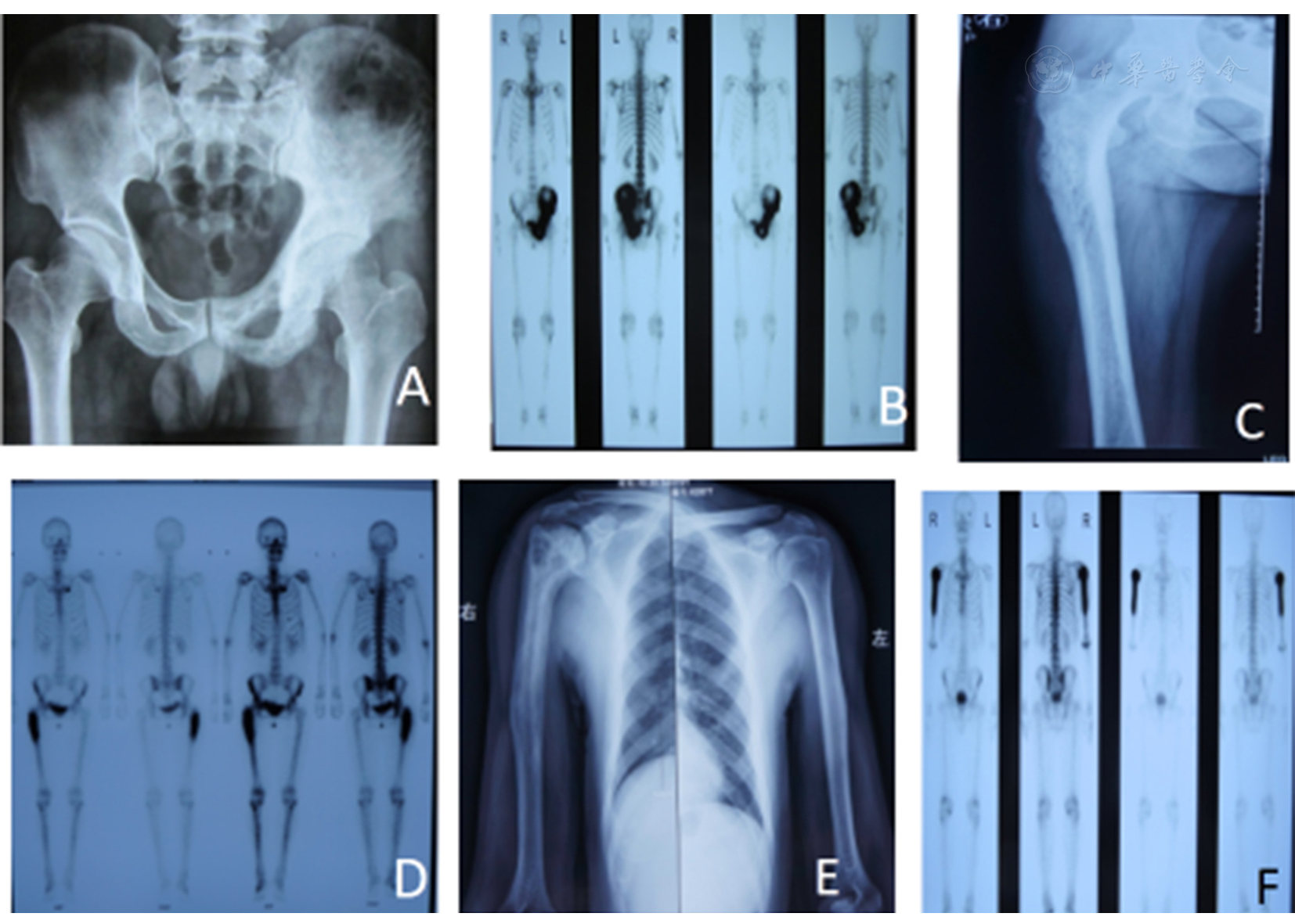 不同类型骨髓炎的影像学表现