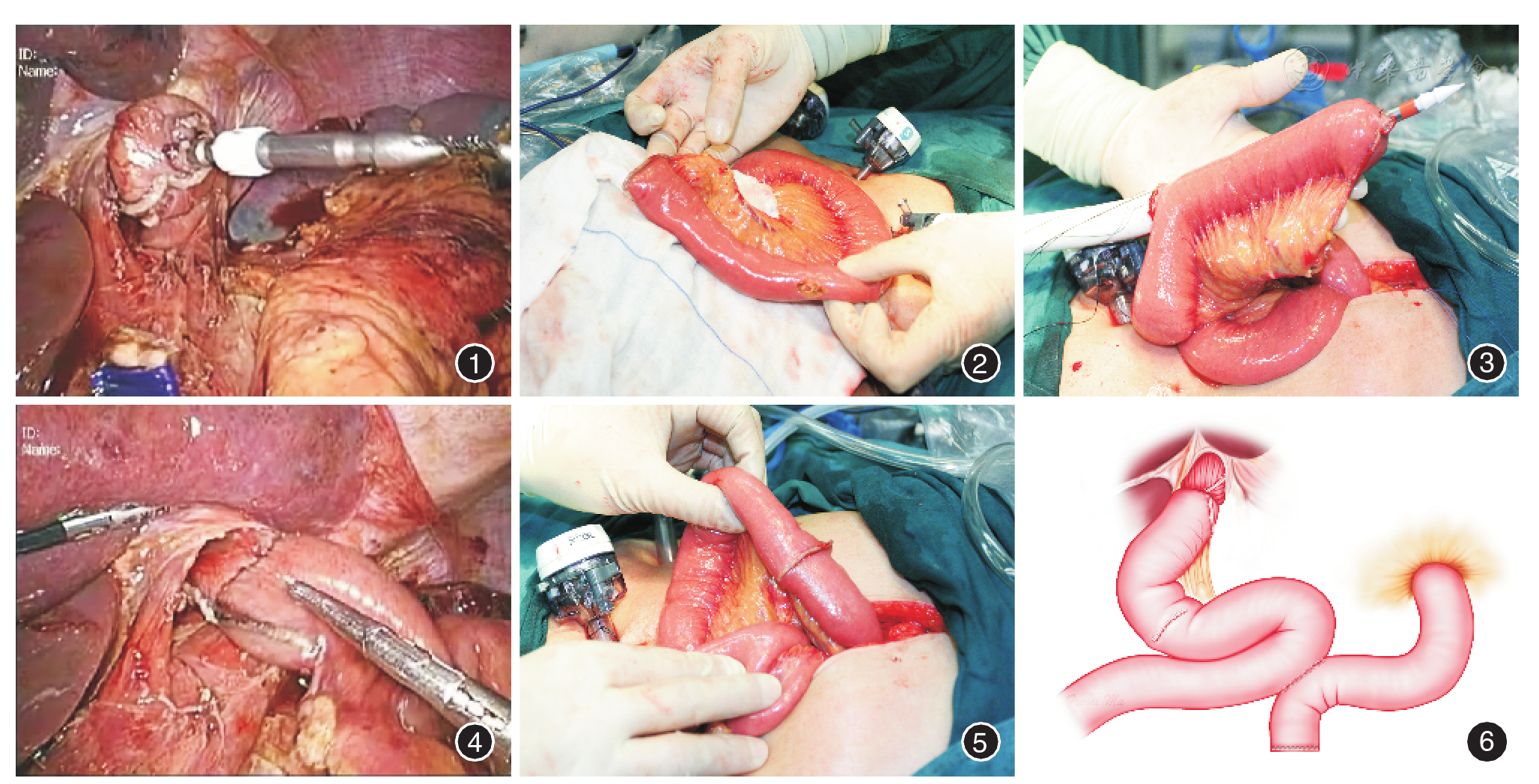 腹腔镜全胃切除术后食管空肠半端端吻合21例
