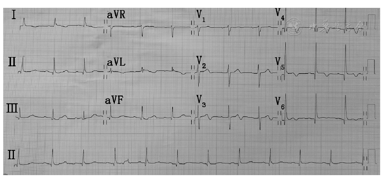 心電圖st段下斜型壓低合併t波高尖的急性心肌梗死一例
