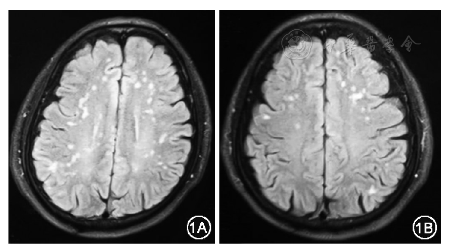 重视前庭性偏头痛与多发腔隙性脑梗死的鉴别诊断