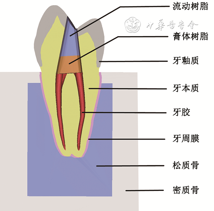 直线通路微创开髓洞型对上颌第一前磨牙力学性能影响的有限元分析
