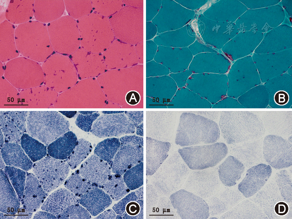 谷氨酰胺–果糖–6–磷酸转氨酶1相关性肢带型先天性