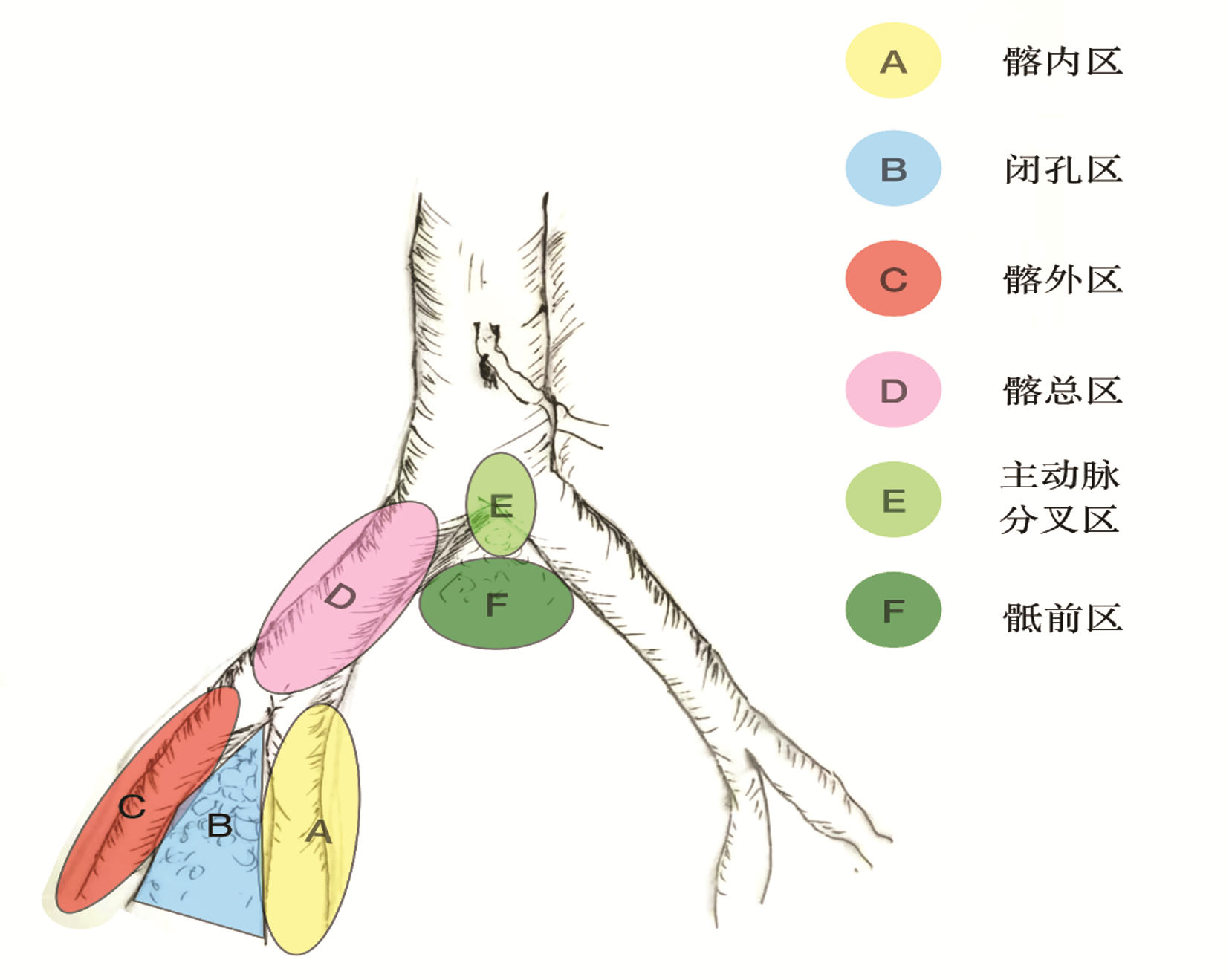 直肠癌侧方淋巴结的概念与侧方淋巴结清扫的争议
